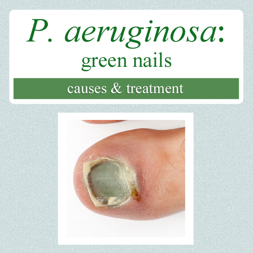 Infected Hangnail Due To Bacterial Infection From Ingrown Nail On Thumb  Stock Photo - Download Image Now - iStock