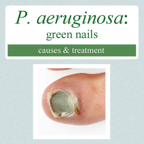 Nail Clinic: Pseudomonas aeruginosa: Green Bacterial Infection | Nailpro
