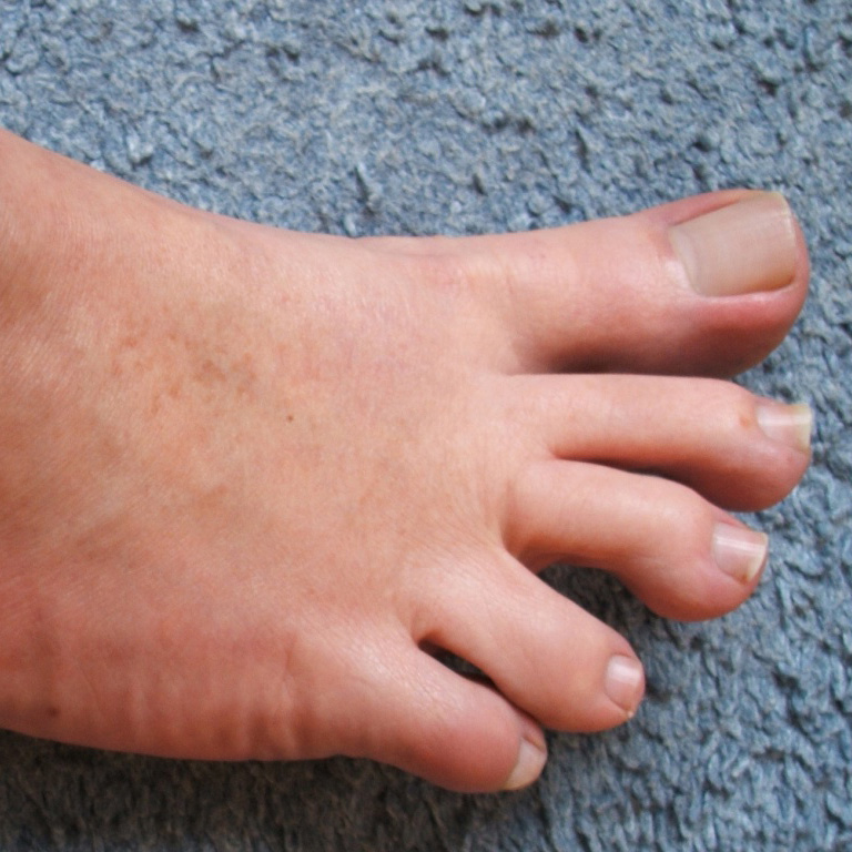 5 Common Toe Problems and Their Causes | Nailpro