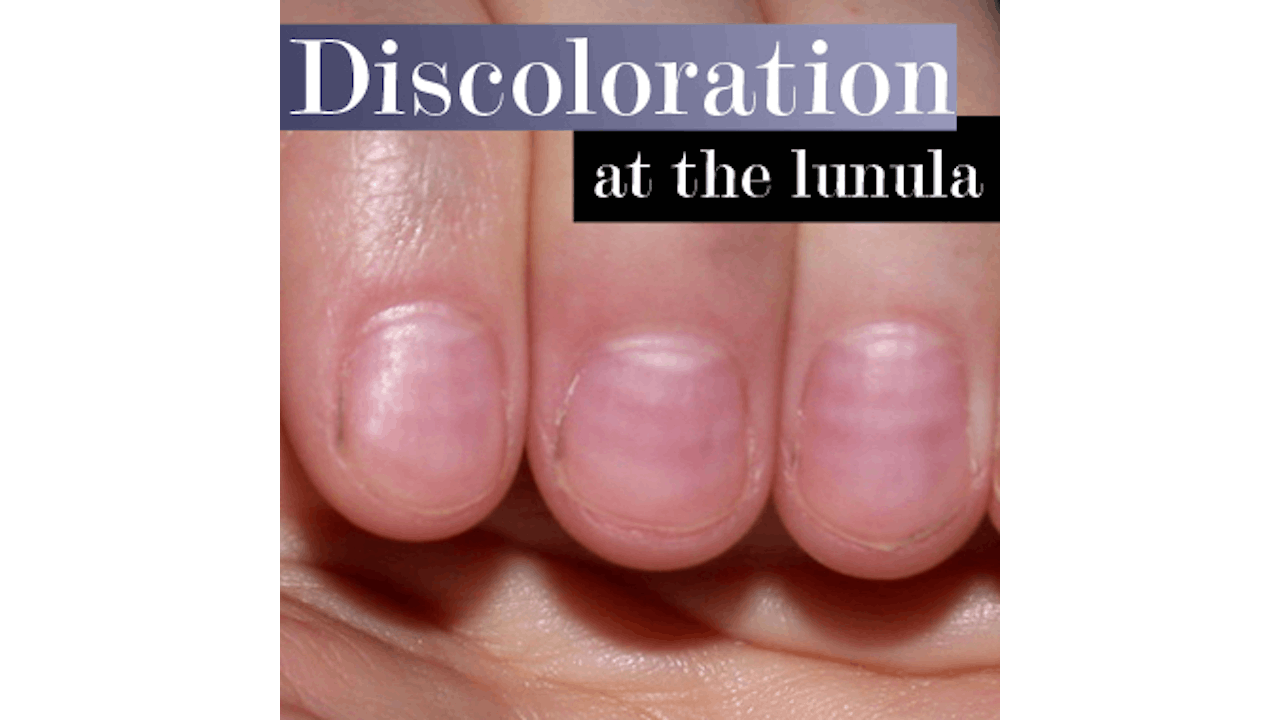 What Nails Discolored at the Moons Mean | Nailpro