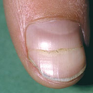 Nail Clinic Beau S Lines Nailpro