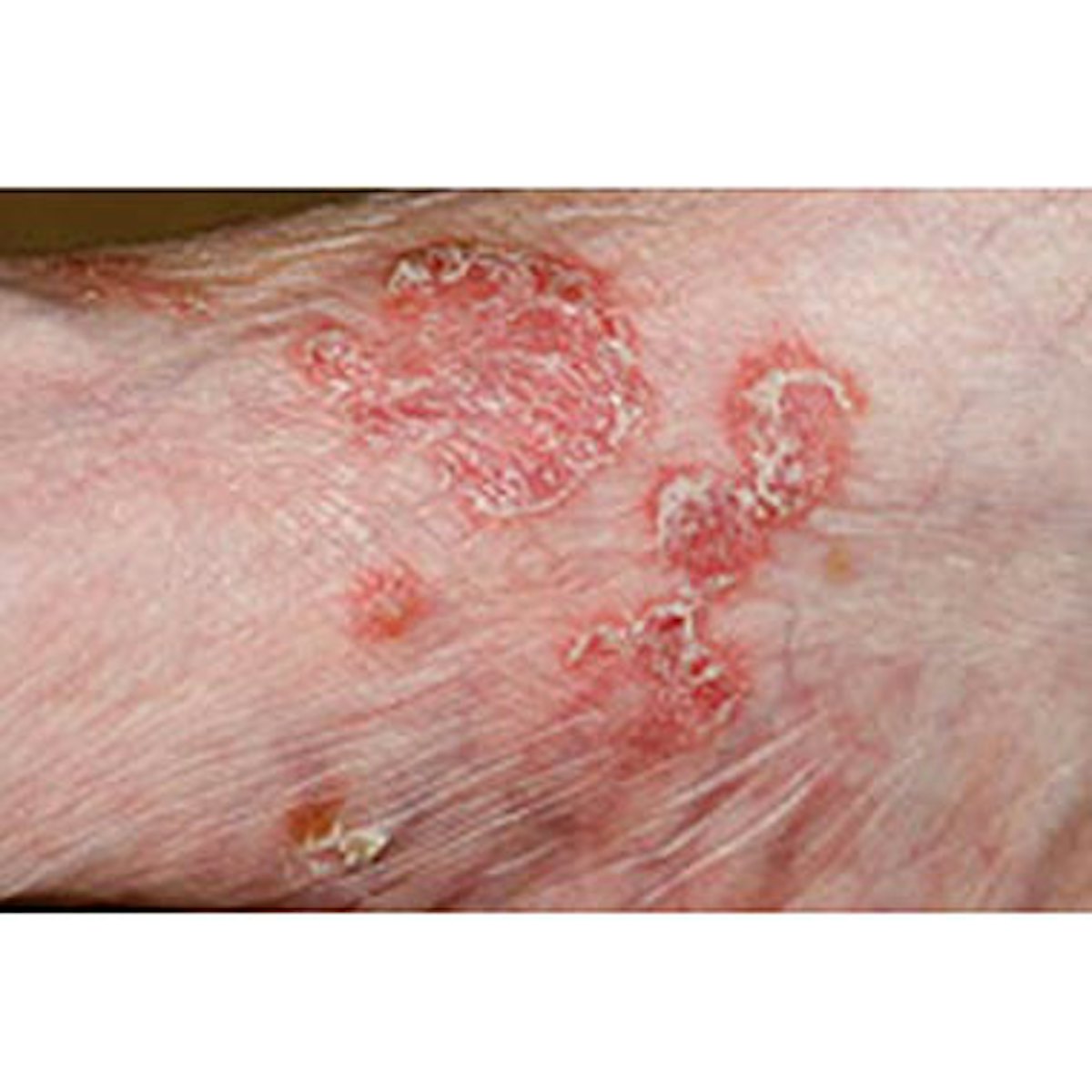 Nail Clinic: Psoriasis | Nailpro