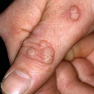 warts on hands keep coming back