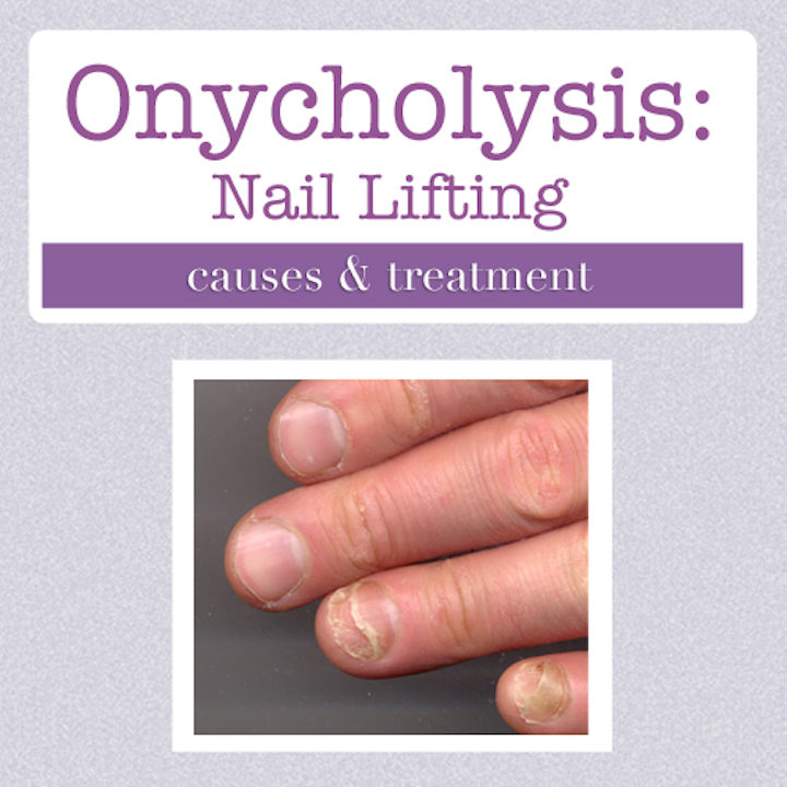 Nail Clinic Onycholysis What It Looks Like Causes And Treatment Nailpro