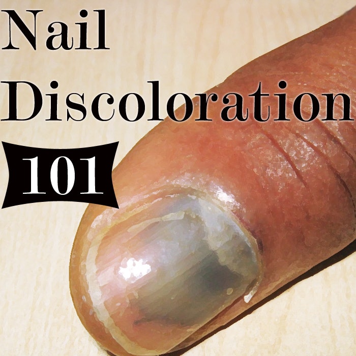 What Discoloration of the Nail Means | Nailpro