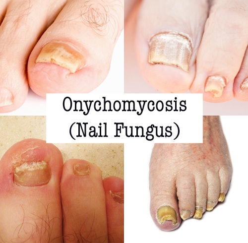 Onychomycosis: Types of Nail Fungus, Causes, and Symptoms | Nailpro