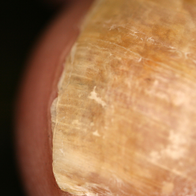 Thick Toenails Causes and Treatment Nailpro