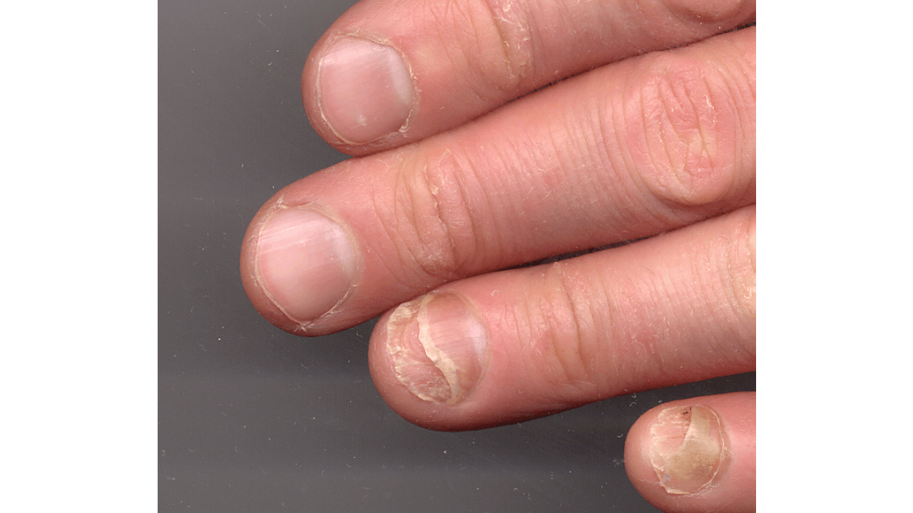 Nail Clinic: Onycholysis: What It Looks Like, Causes, and Treatment |  Nailpro