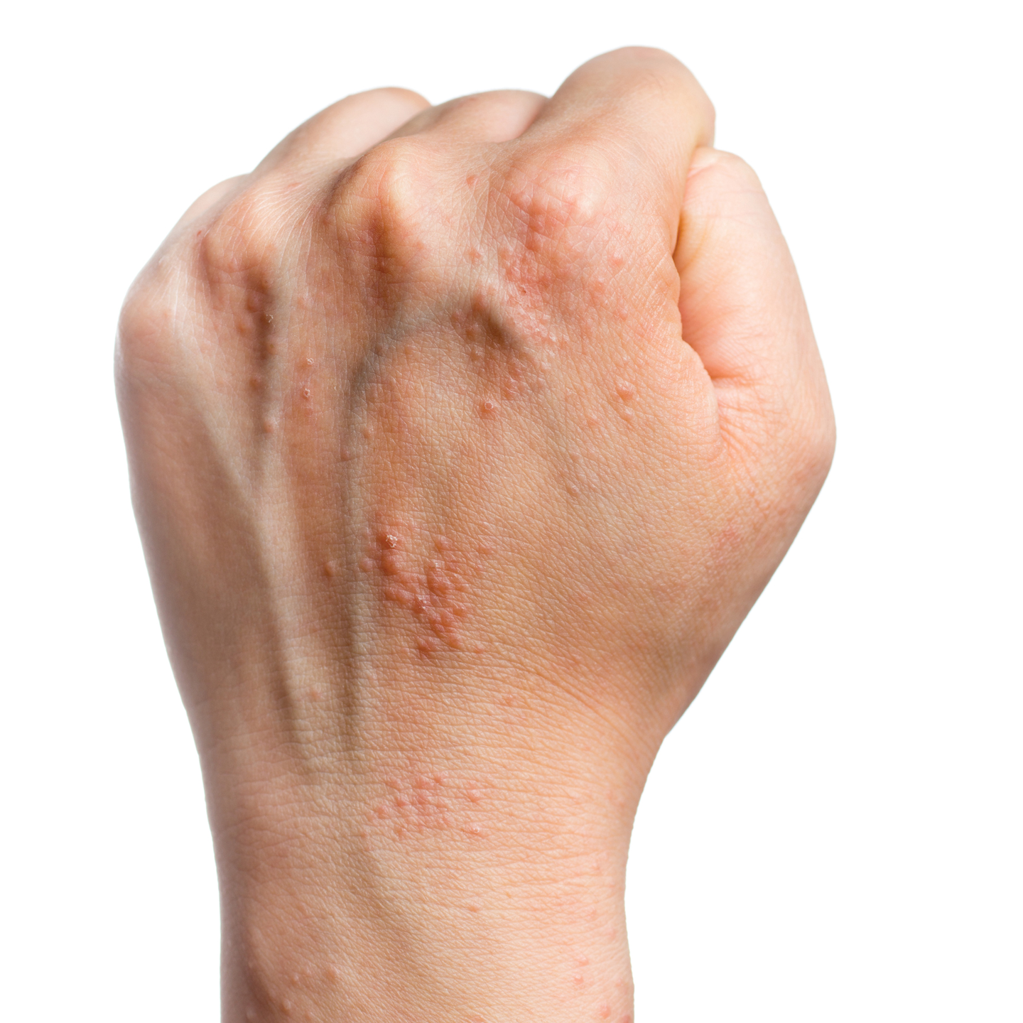 Nail Clinic Allergy Or Irritation Nailpro