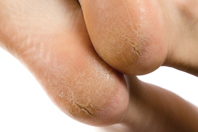 Dry soles of feet on sale