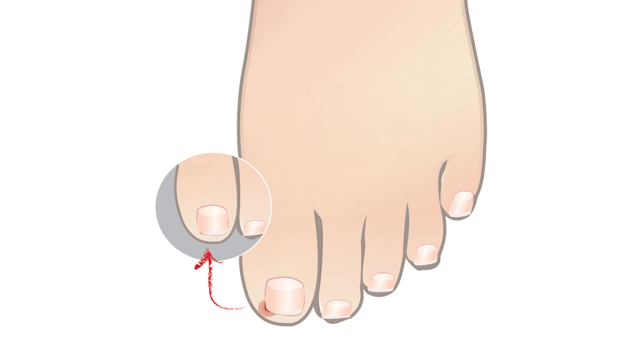 Top 9 Do's and Don'ts for Handling Ingrown Toenails | Nailpro