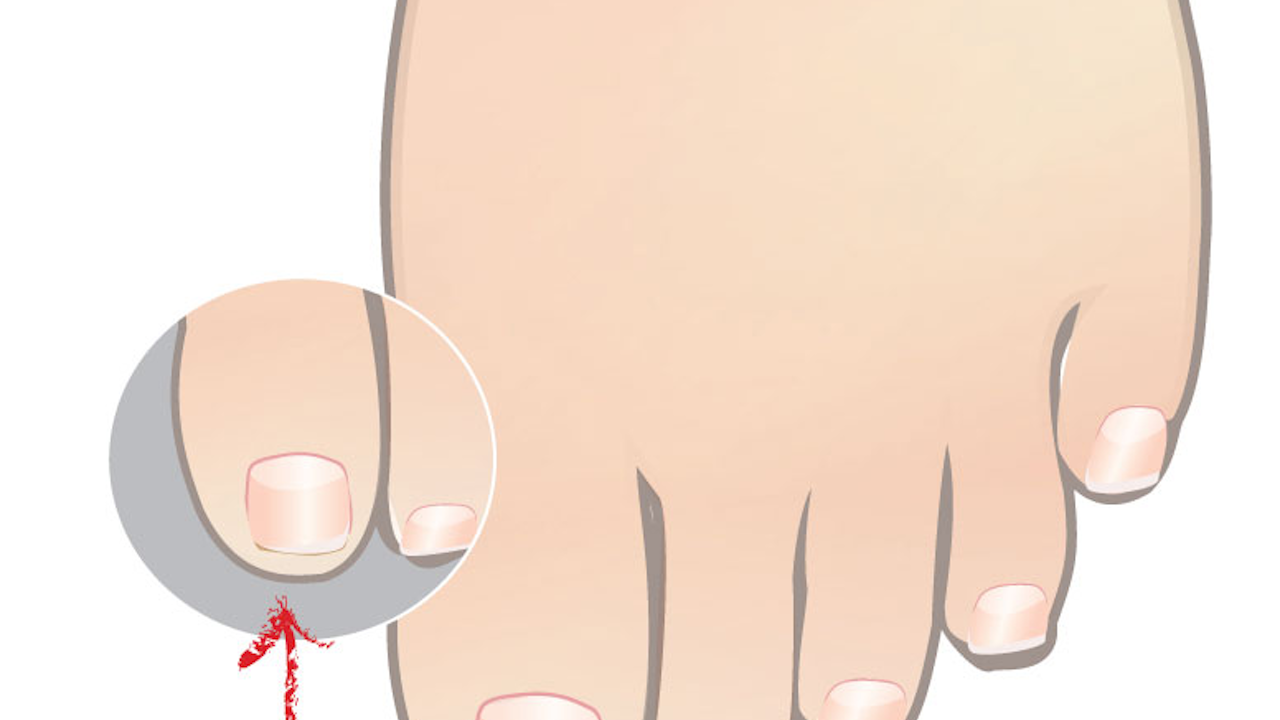Ingrown Toenails Finding A Cure Cherrywood Foot Care