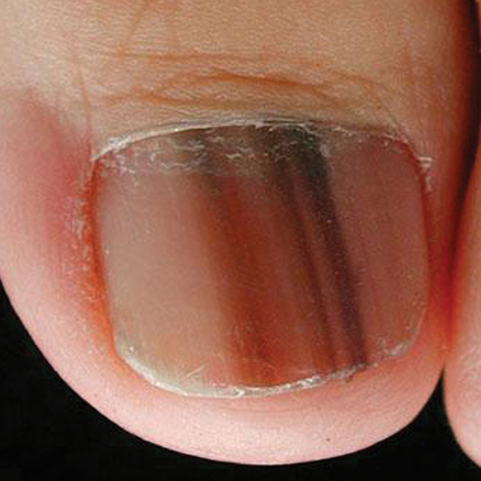 Melanoma Of The Nail: Detection, Symptoms, And Treatment