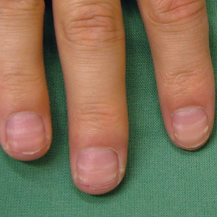 What To Do If Your Client Has Beau S Lines Nailpro