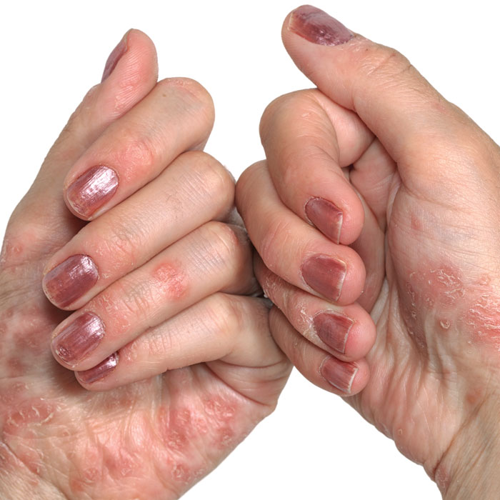 Dactylitis: A hallmark of psoriatic arthritis - ScienceDirect