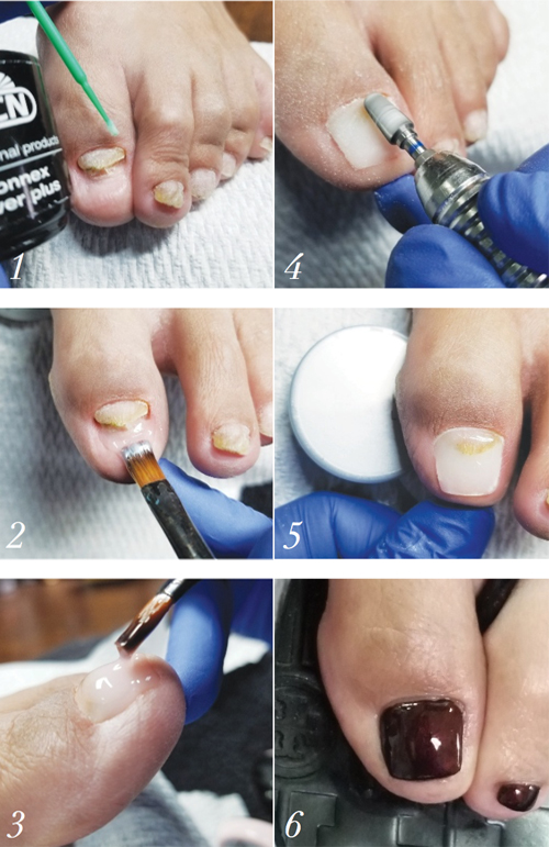 How To Service Clients In Need Of Toenail Reconstruction Nailpro How To Service Clients In Need Of Toenail Reconstruction Nailpro
