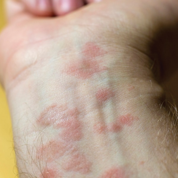Nail Clinic: Dermatitis | Nailpro Nail Clinic: Dermatitis | Nailpro