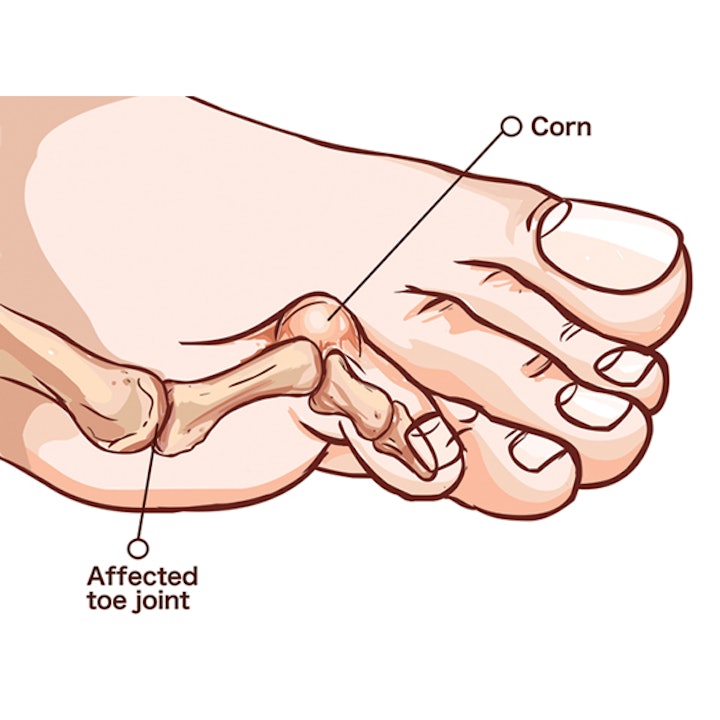 Hammer Toe Symptoms and Treatment Cincinnati and Dayton OH