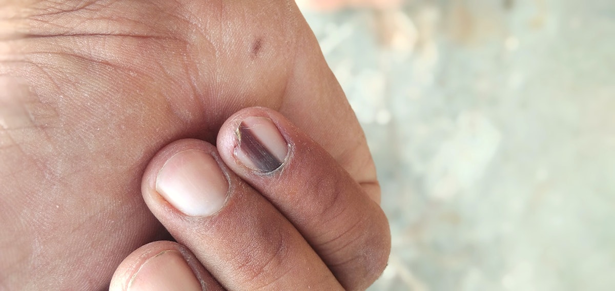 6 Red Flags Via Nail Appearance Nailpro 6 Red Flags Via Nail Appearance Nailpro