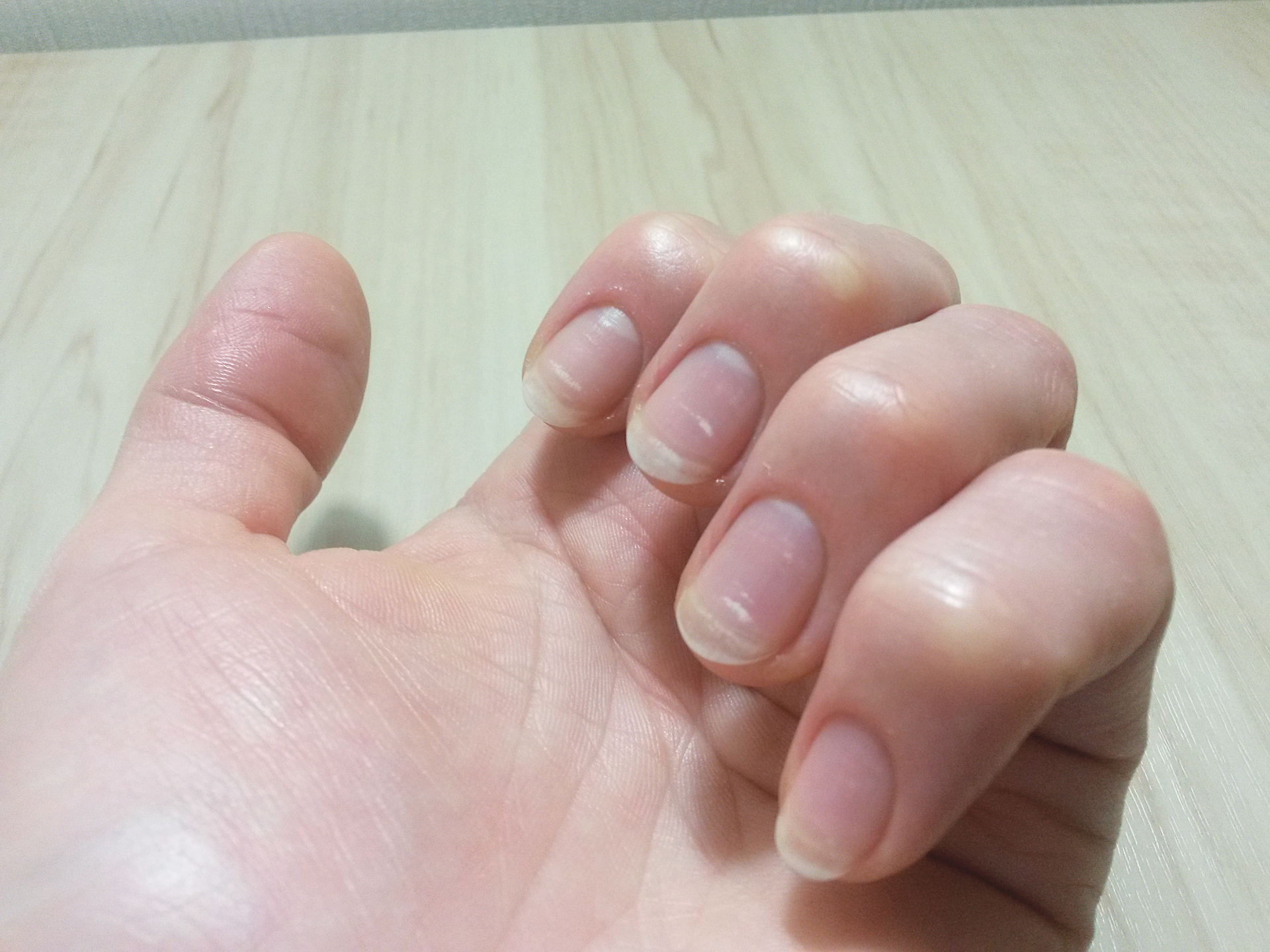 An Atlas of Nail Disorders, Part 3 | Consultant360